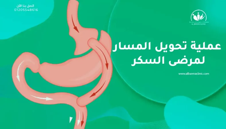 عملية تحويل المسار لمرضى السكر