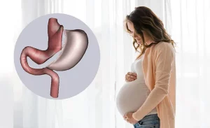 هل عملية التكميم تؤثر على الحمل والإنجاب