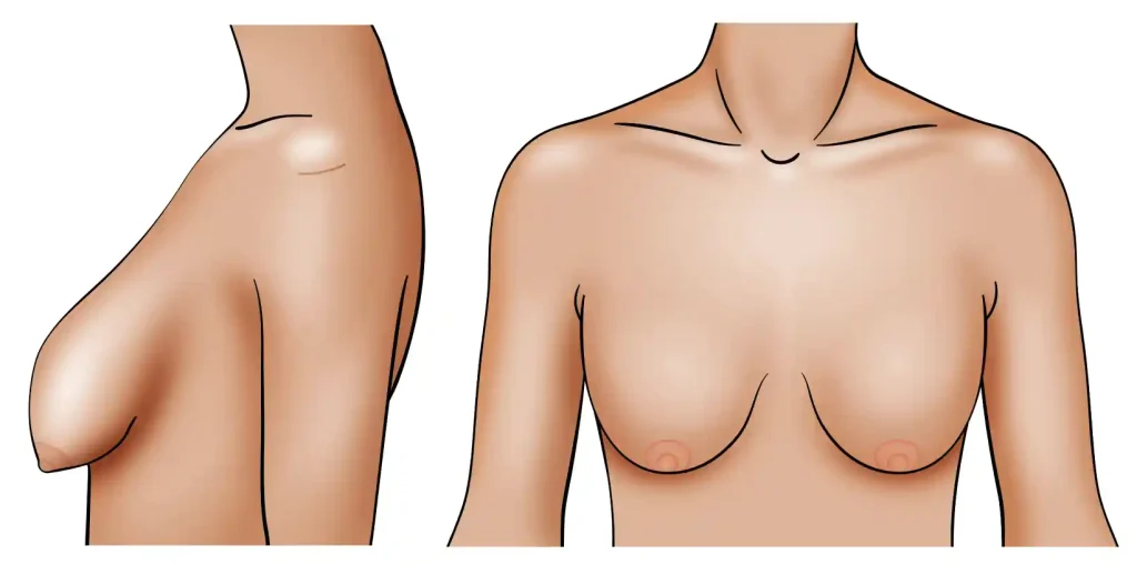 شكل الثدي المترهل 